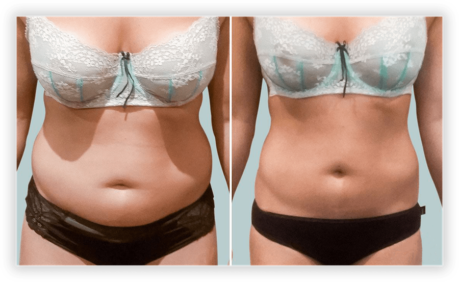 Non Surgical Facelift 2